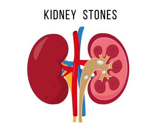 Kidney Stones