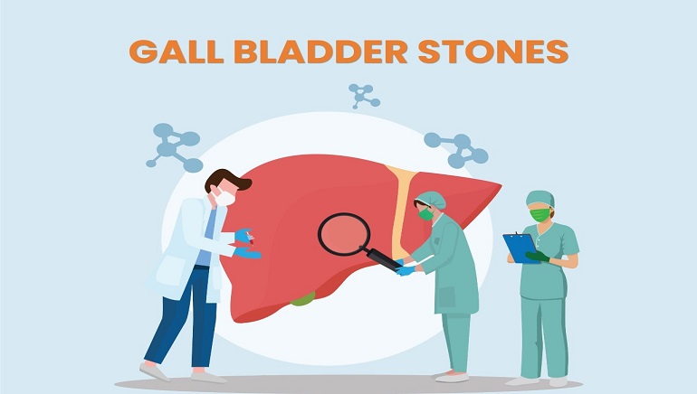 Gall Bladder Stones